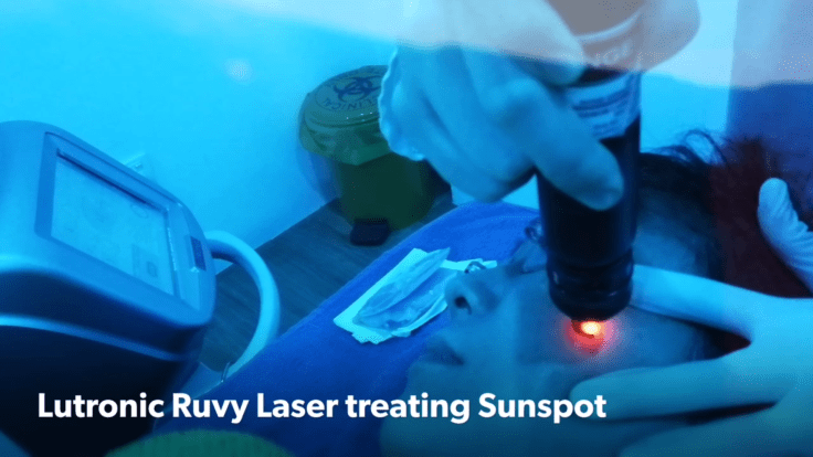 Lutronic Ruvy Laser
