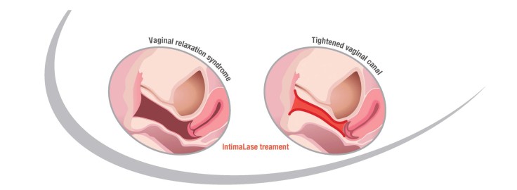 Laser Vaginal Tightening Fotona Intimalase Beau &amp; Hans