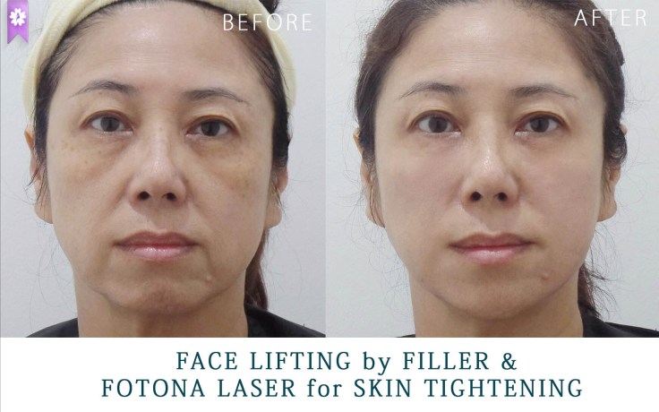 facelift by filler and fotona laser (2)