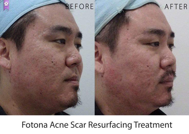 before after side R_mix01