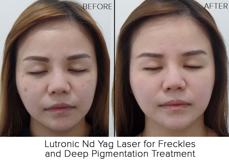 front before after resize