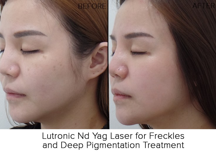 left before after resize